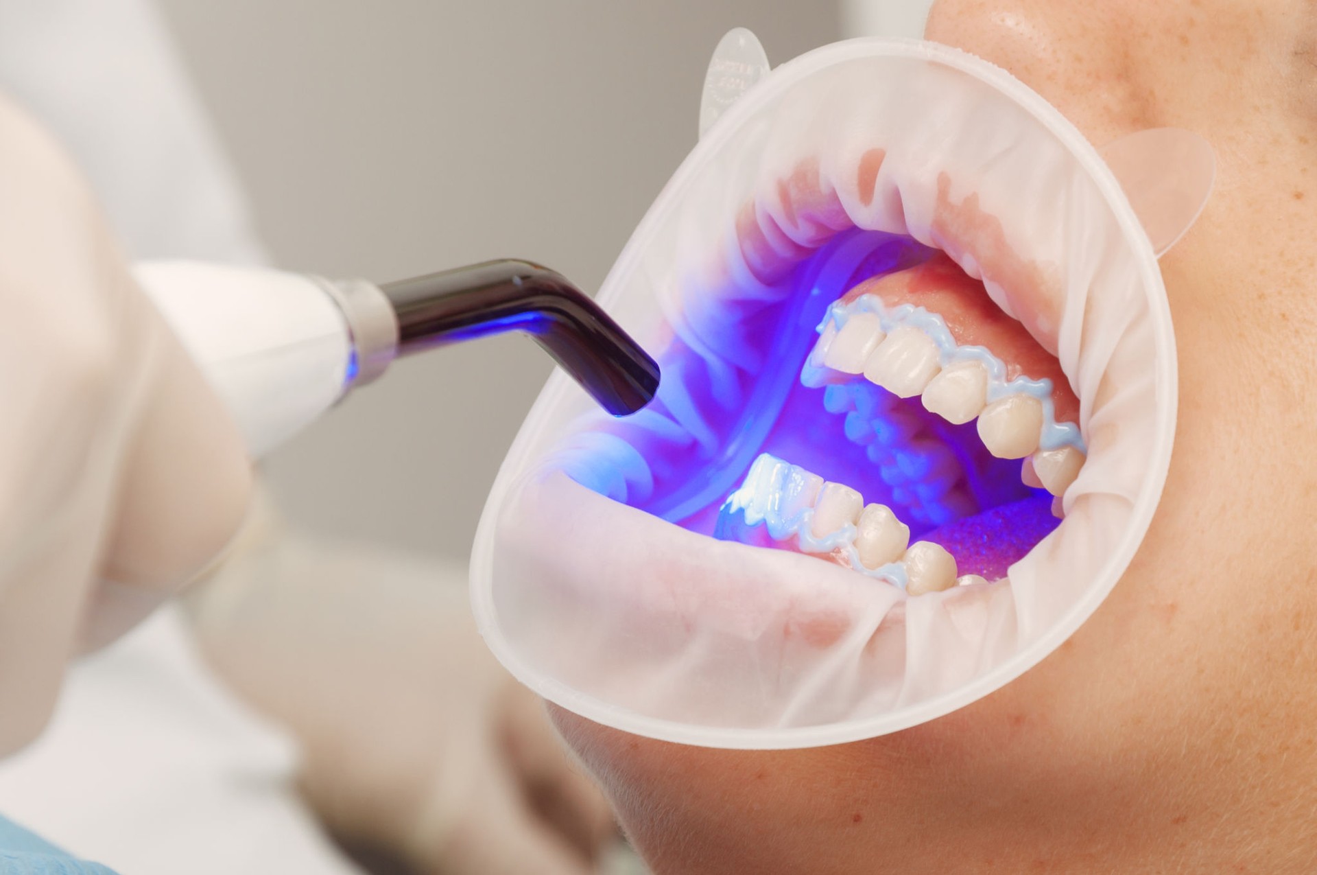 Close-up of a dentist using ultraviolet light for a tooth whitening treatment. No face, unrecognizable person